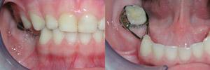 Удаления зубов должен производить детский стоматолог