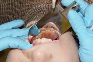 зуб был обработан необходимыми лечебными средствами