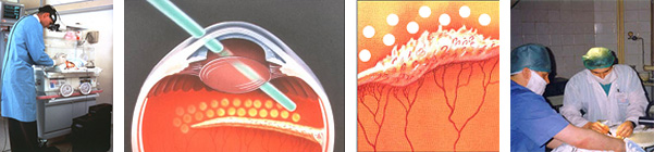 Лазерная коагуляция после операции. Ретинопатия недоношенных лазеркоагуляция. Лазеркоагуляция сетчатки при ретинопатии недоношенных. Панретинальная лазерная коагуляция. Отслойка сетчатки операция.